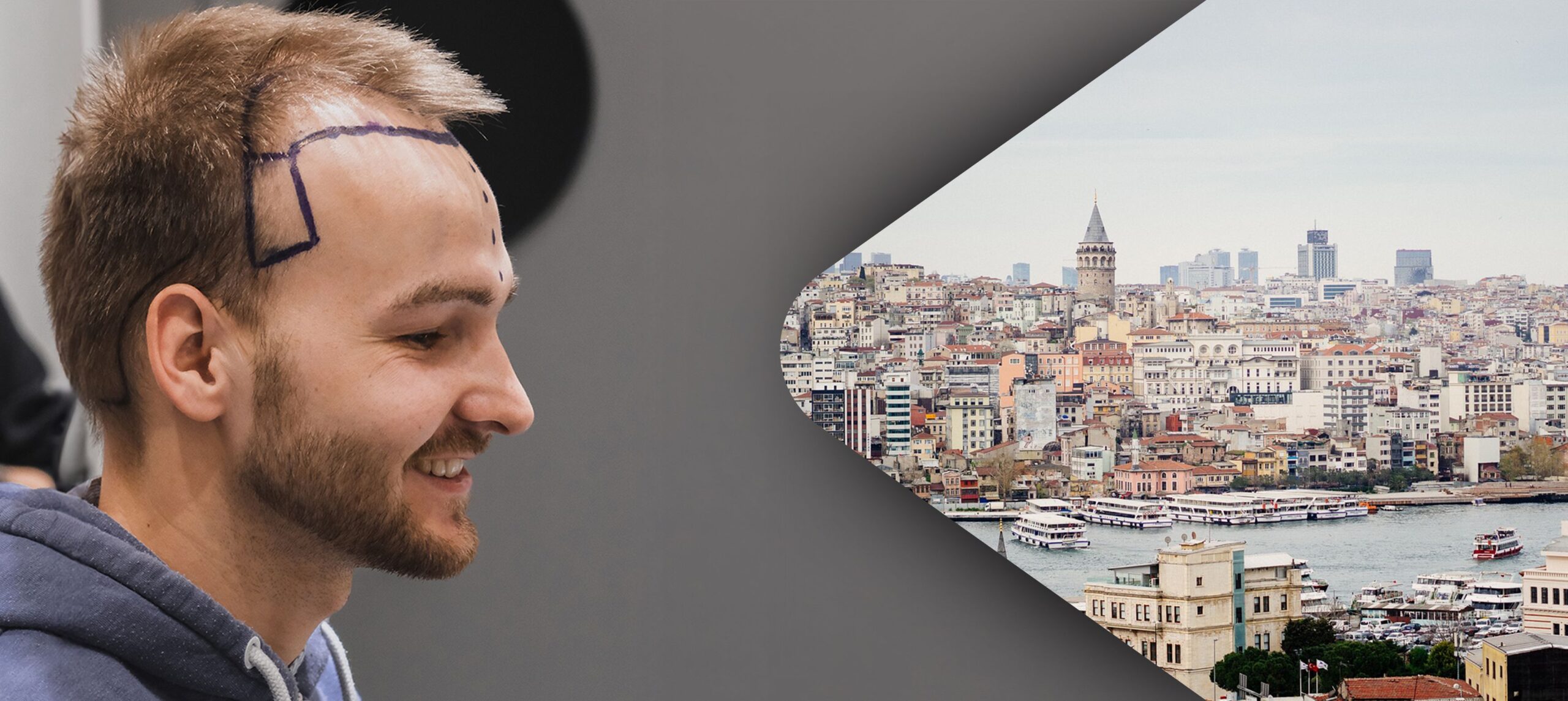 Titelbild zu „Haartransplantation in der Türkei: Erfahrungen, Methoden und Kosten im Überblick“